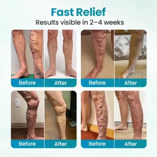 Croaie® VeinAway Relief Cream