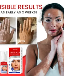 Croaie® Vitiligo Treatment Spray
