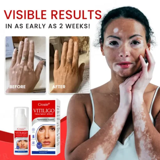 Croaie® Vitiligo Treatment Spray