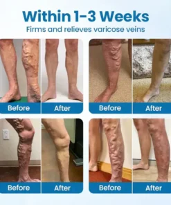 Croaie® VenoEase Herbal Spray