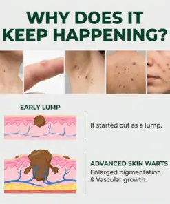 Croaie® WartClear Botanical Treatment Cream